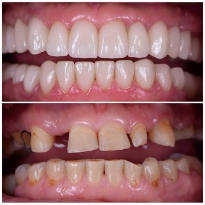 Smile Makeover Before & After