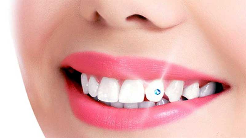 Teeth Whitening