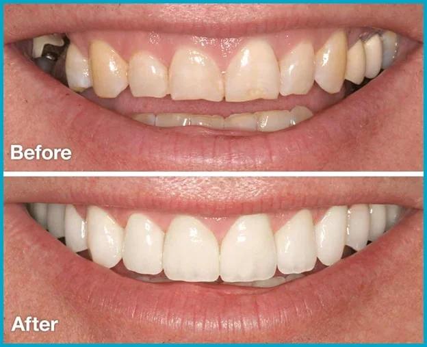 Veneers Before & After