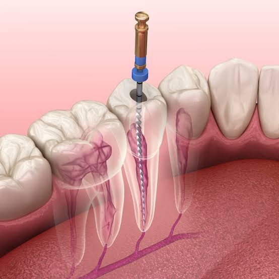 Dental Implant