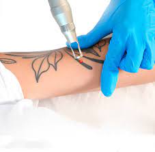 Laser Treatment