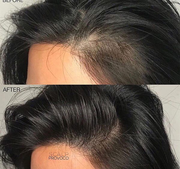 Hair Regrowth Before After