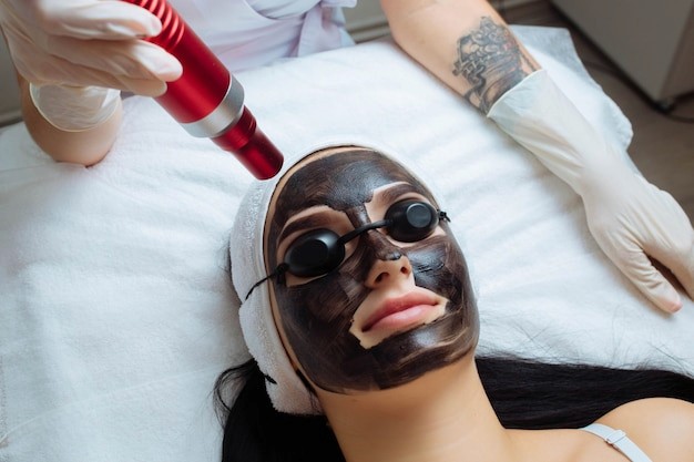 Carbon Laser Facial