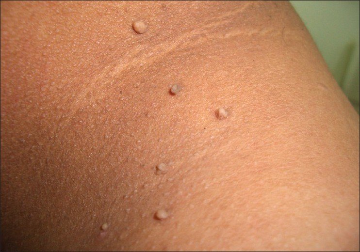 Skin Tags Warts Removal