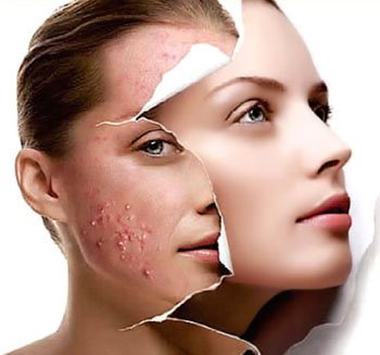 Acne Treatment Before After