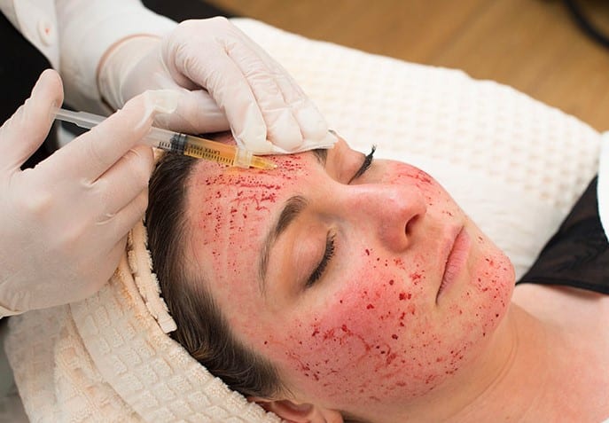 PRP Face Therapy