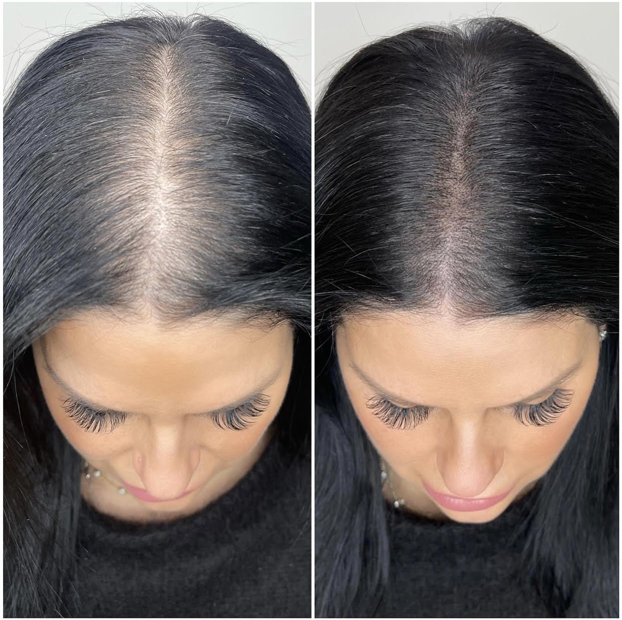 Hair Restoration Results