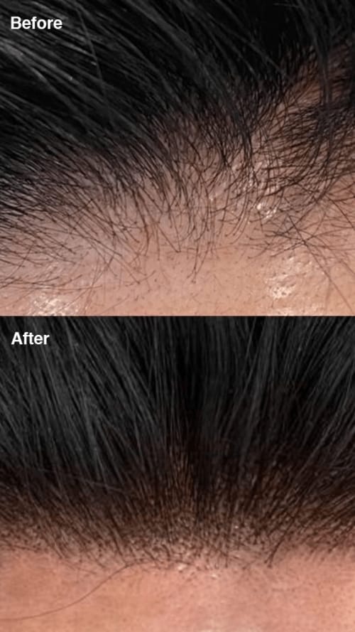 Hair Restoration Before After